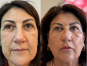 Template de post feed antes e depois (4) 2